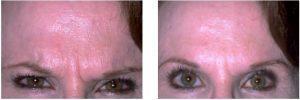 Botox Before And After By Dr. Surjit S. Rai, MD, Dallas TX Physician (2)