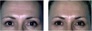 Botox Before And After By Dr. Surjit S. Rai, MD, Dallas TX Physician (3)