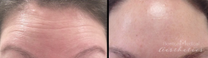 Botox Before And After By JENNIFER CANESI, APN-BC, Board Certified Adult Nurse Practitioner In Boston (1)