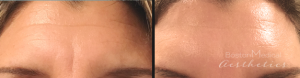 Botox Before And After By JENNIFER CANESI, APN-BC, Board Certified Adult Nurse Practitioner In Boston (2)