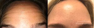 Botox Before And After By JENNIFER CANESI, APN-BC, Board Certified Adult Nurse Practitioner In Boston (3)
