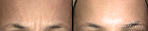 Botox Before And After By JENNIFER CANESI, APN-BC, Board Certified Adult Nurse Practitioner In Boston (4)