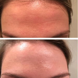 Botox Before And After By JENNIFER CANESI, APN-BC, Board Certified Adult Nurse Practitioner In Boston (5)