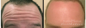 Botox Before And After By JENNIFER CANESI, APN-BC, Board Certified Adult Nurse Practitioner In Boston (6)