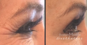 Botox Before And After By JENNIFER CANESI, APN-BC, Board Certified Adult Nurse Practitioner In Boston (7)