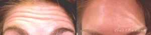 Botox Before And After By JENNIFER CANESI, APN-BC, Board Certified Adult Nurse Practitioner In Boston (8)