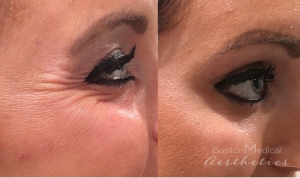 Botox Before And After By JENNIFER CANESI, APN-BC, Board Certified Adult Nurse Practitioner In Boston (9)