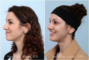 Botox Before And After By Veronica Jones, RN At Mirror Mirror Beauty Boutique In Houston, Texas (1)