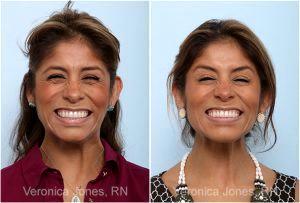 Botox Before And After By Veronica Jones, RN At Mirror Mirror Beauty Boutique In Houston, Texas (2)