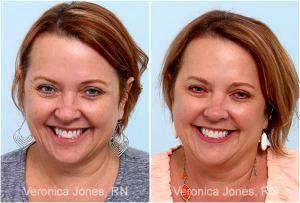 Botox Before And After By Veronica Jones, RN At Mirror Mirror Beauty Boutique In Houston, Texas (3)