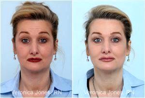 Botox Before And After By Veronica Jones, RN At Mirror Mirror Beauty Boutique In Houston, Texas (4)