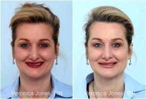 Botox Before And After By Veronica Jones, RN At Mirror Mirror Beauty Boutique In Houston, Texas (5)