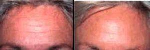 Botox Before And After With Dr Amiya Prasad, MD, New York Oculoplastic Surgeon