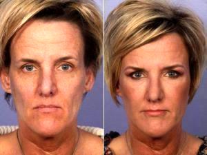 Botox Before And After With Dr. Grant Stevens, MD, Los Angeles Plastic Surgeon