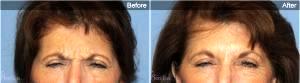 Botox Between Eyebrows By Dr. Robert G. Bonillas, MD, Scottsdale AZ Plastic Surgeon