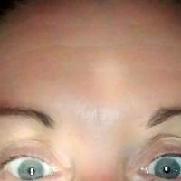 Botox Between Eyebrows Results