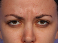 Botox Between Eyebrows With Dr. Grant Stevens, MD, Los Angeles Plastic Surgeon