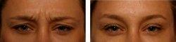 Botox Between Eyebrows With Dr. Richard W. Fleming, MD, Beverly Hills Facial Plastic Surgeon