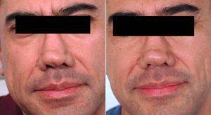 Botox Between The Eyes Before And After By Dr Harold J. Kaplan, MD, Los Angeles Facial Plastic Surgeon