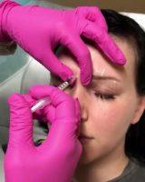 Botox Brow Lift Can Be Performed On All Skin Types