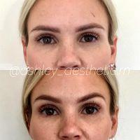 Botox Brow Lift Can Improve The Position And Shape Of The Eyebrow