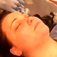 Botox Brow Lift Injection Sites