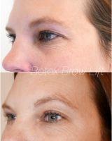 Botox Brow Lift Picture Before And After