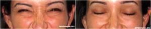 Botox By Dr. Edward Zimmerman, Plastic Surgeon In The Clark County, Nevada (2)