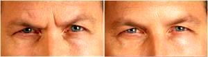 Botox By Dr. Mike Majmundar, MD, Alpharetta GA Facial Plastic Surgeon