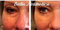 Botox Can Be Used Under The Eyes By Confident And Trained Injectors