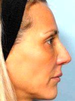 Botox Combined With Radiesse With Doctor Joseph A. Eviatar, MD, FACS, New York Oculoplastic Surgeon