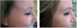 Botox Cosmetic In The Forehead, Glabella And Crowsfeet Areas By Dr. Steven Vath, Denver Cosmetic Plastic Surgeon (1)