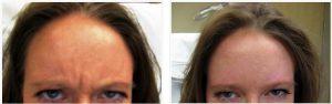 Botox Cosmetic In The Forehead, Glabella And Crowsfeet Areas By Dr. Steven Vath, Denver Cosmetic Plastic Surgeon (2)