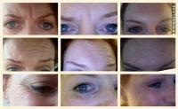 Botox Cosmetic Injections Are Commonly Used To Treat Motion Wrinkles
