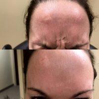 Botox Cosmetic Is FDA-approved To Smooth The Frown Lines Between Your Eyebrows