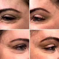 Botox Effect Is Obtained Two Weeks After The Injections