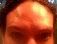 Botox Effects Forehead