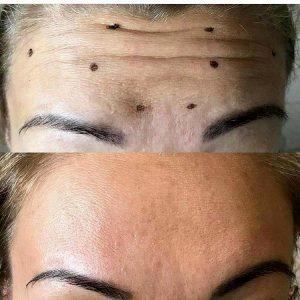 Botox Erase Forehead Lines Pic