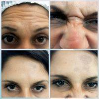 Botox & Filler For Frown Lines