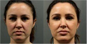 Botox For Brow Lift, To Forehead, Glabella; Filler To Lips And Tear Troughs By Ashley Gordon, MD, FACS, Austin Female Plastic Surgeon