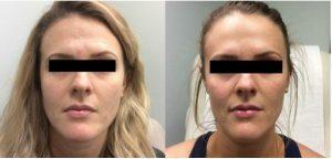 Botox For Chemical Brow Lift, To Forehead, Glabella, And Crow's Feet By Ashley Gordon, MD, FACS, Austin Female Plastic Surgeon