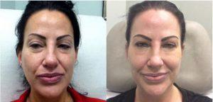 Botox For Chemical Brow Lift, To Forehead, Glabella And Crow's Feet; Filler To Tear Troughs, And Midface; Chemical Peels By Dustin Reid, MD, FACS , Austin Plastic Surgeon