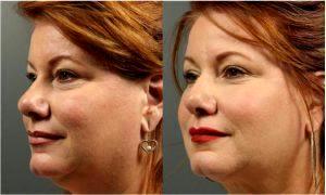 Botox For Chemical Brow Lift, To Forehead, Glabella By Ashley Gordon, MD, FACS, Austin Female Plastic Surgeon