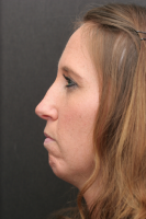 Botox For Creases In Chin With Dr. Stuart H. Bentkover, MD , Boston Facial Plastic Surgeon