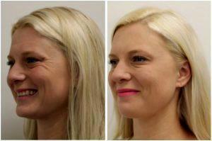 Botox For Crows Feet By Onna Feuchter, Injector, Skin, And Laser Specialist In Southlake, Texas (2)