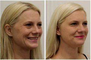 Botox For Crows Feet By Onna Feuchter, Injector, Skin, And Laser Specialist In Southlake, Texas (3)
