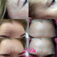 Botox For Crows Feet, Forehead And Frown Wrinkles Before And After