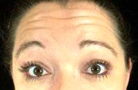 Botox For Deep Forehead Wrinkles With Doctor Monica Scheel, MD, Kailua Kona Dermatologist