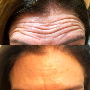 Botox For Deep Lines In Forehead