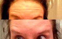 Botox For Forehead A.k.a. Botulinum Toxin Injections